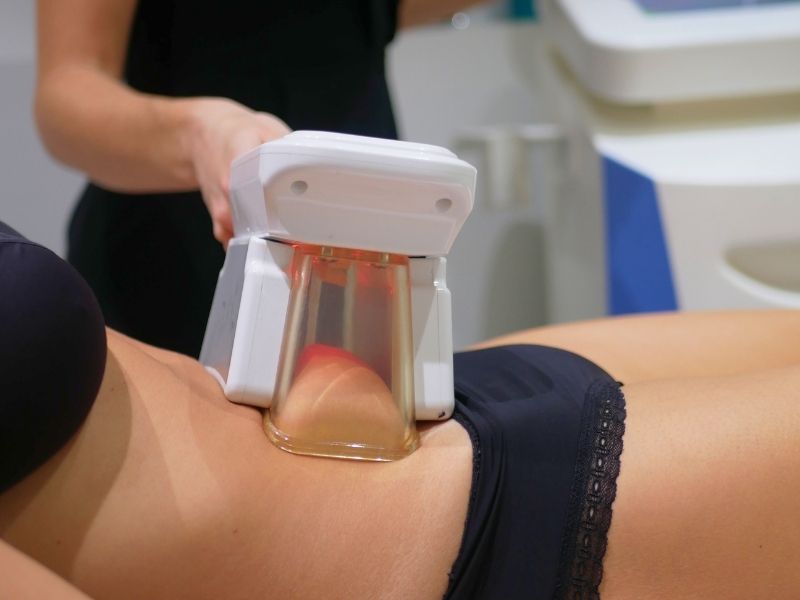 Cryolipolyse sur le ventre pour réduire les amas graisseux à Ovale & Sens Montpellier